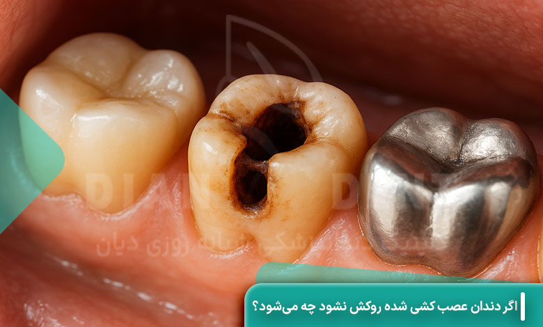 اگر دندان عصب کشی شده روکش نشود چه می‌شود؟