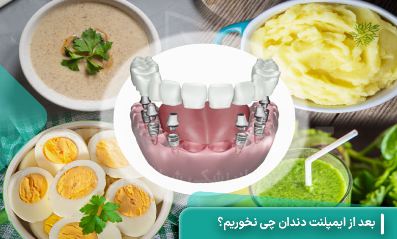بعد از ایمپلنت دندان چی نخوریم؟