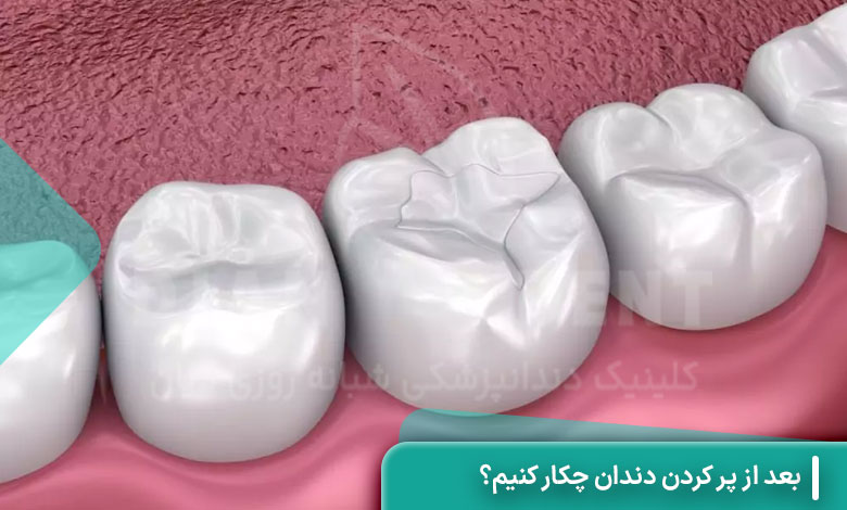 بعد از پر کردن دندان چکار کنیم؟