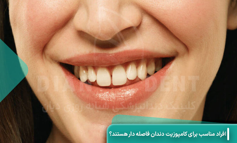 چه افرادی کاندیدای مناسب برای کامپوزیت دندان فاصله ‌دار هستند؟