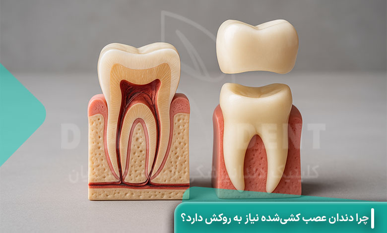 چرا دندان عصب کشی‌شده نیاز به روکش دارد؟