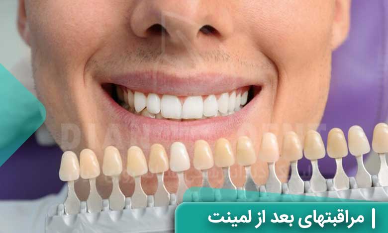 مراقبتهای بعد از لمینت دندان