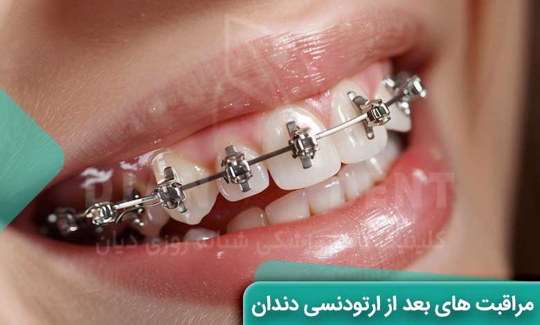 مراقبت های بعد از ارتودنسی دندان