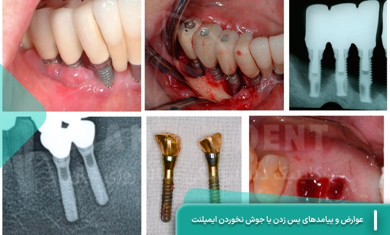 عوارض و پیامدهای پس زدن یا جوش نخوردن ایمپلنت