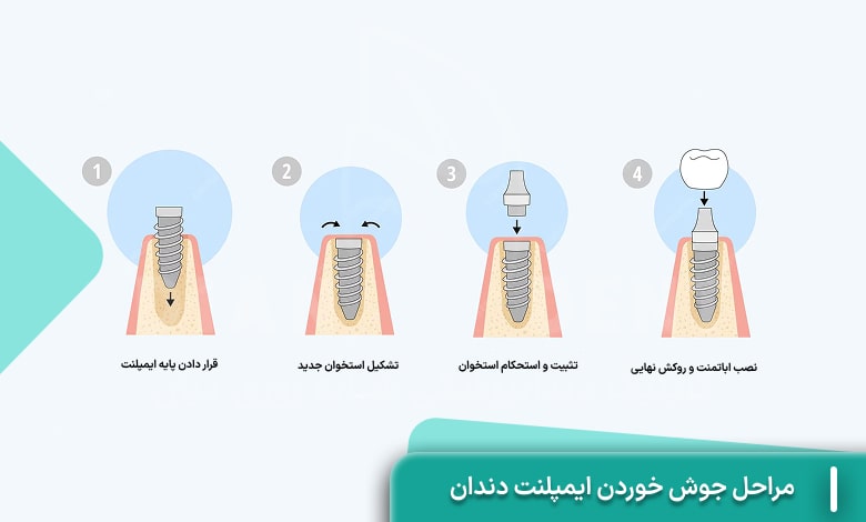 مراحل جوش خوردن ایمپلنت دندان