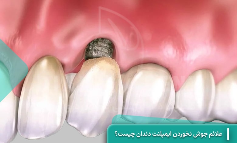 جوش نخوردن ایمپلنت