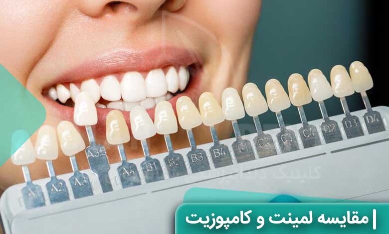 جدول مقایسه لمینت دندان و کامپوزیت دندان