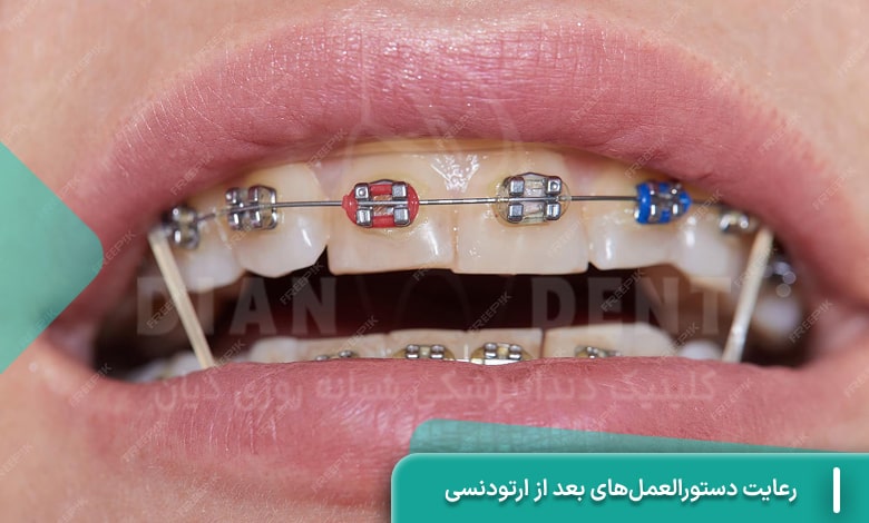 رعایت دستورالعمل‌های بعد از ارتودنسی