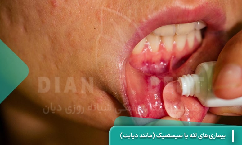 بیماری‌های لثه یا سیستمیک