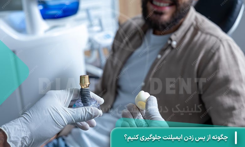 چگونه از پس زدن ایمپلنت جلوگیری کنیم