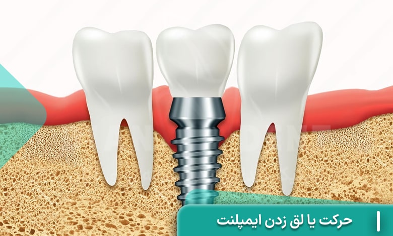 حرکت یا لق زدن ایمپلنت