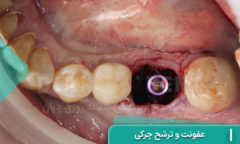 عفونت و ترشح چرکی