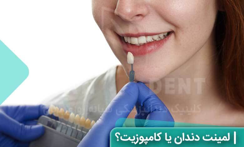 لمینت دندان بهتر است یا کامپوزیت؟
