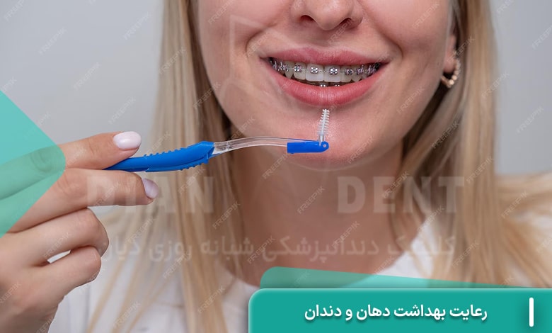 رعایت بهداشت دهان و دندان در دوران ارتودنسی