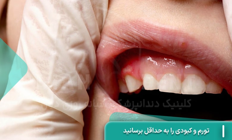 به حداقل رساندن تورم و کبودی دندان