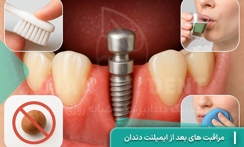 مراقبت های بعد از ایمپلنت دندان