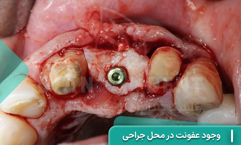 وجود عفونت در محل جراحی