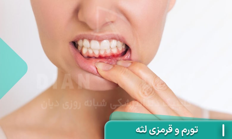 تورم و قرمزی لثه نشانه عدم جوش خوردن ایمپلنت