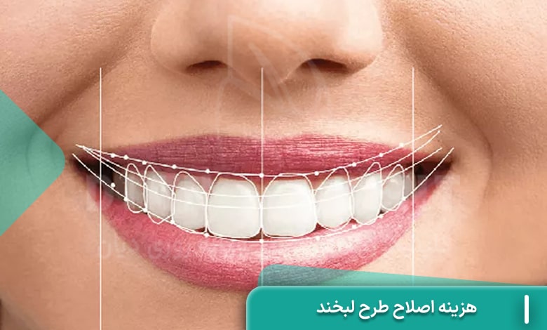 هزینه اصلاخ طرح لبخند