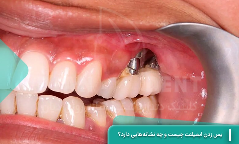 پس زدن ایمپلنت چیست