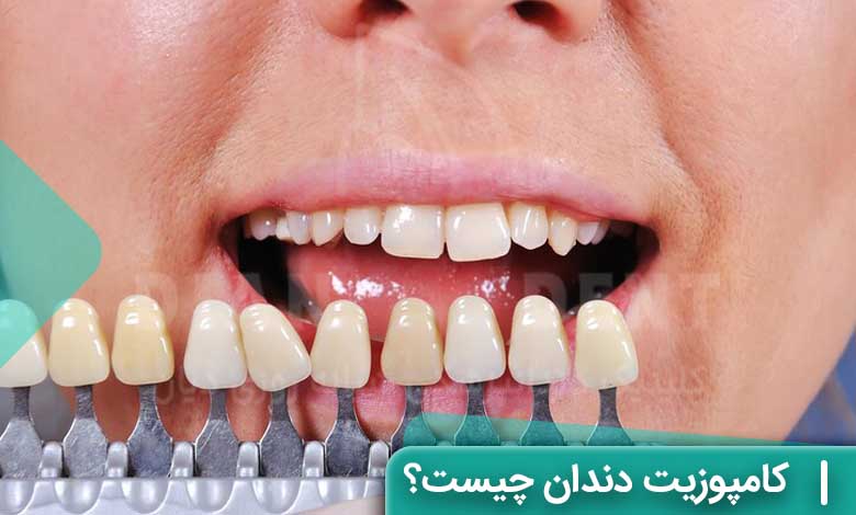 کامپوزیت دندان چیست