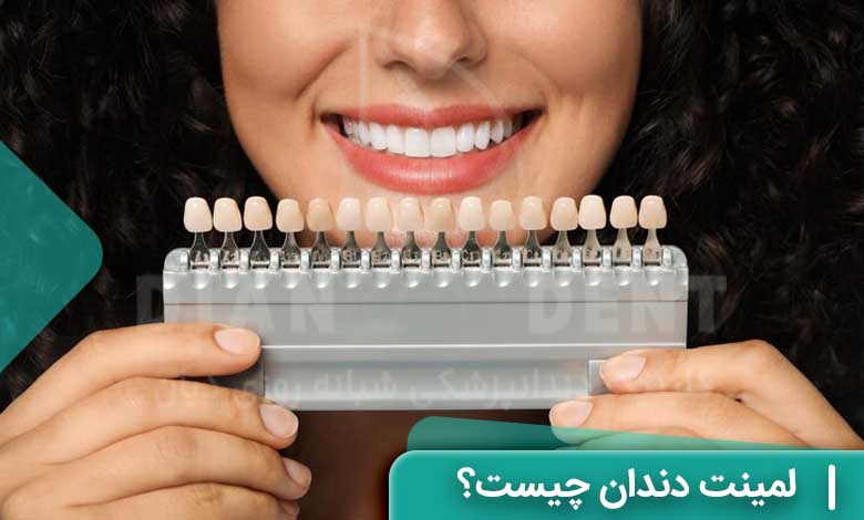 لمینت دندان چیست