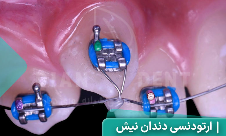 ارتودنسی دندان نیش
