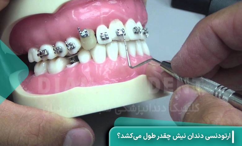 ارتودنسی دندان نیش چقدر طول می‌کشد؟
