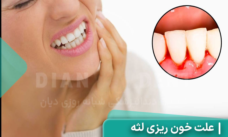 علت خون ریزی لثه