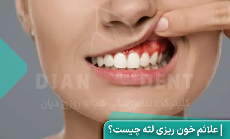علائم خون ریزی لثه چیست؟