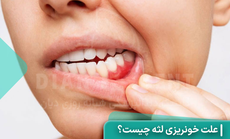 علت خونریزی لثه چیست؟