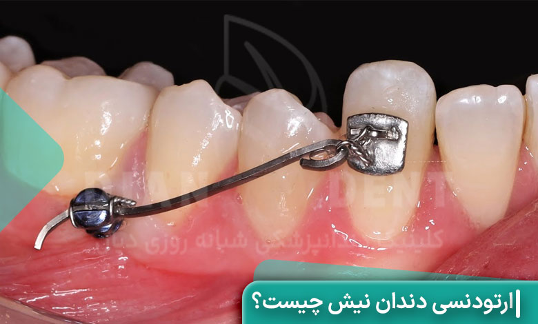 ارتودنسی دندان نیش چیست؟