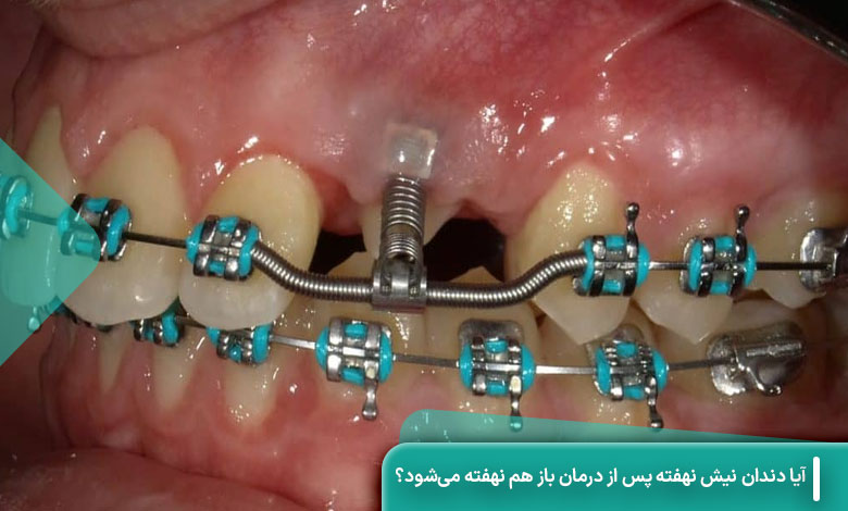 آیا دندان نیش نهفته پس از درمان باز هم نهفته می‌شود؟