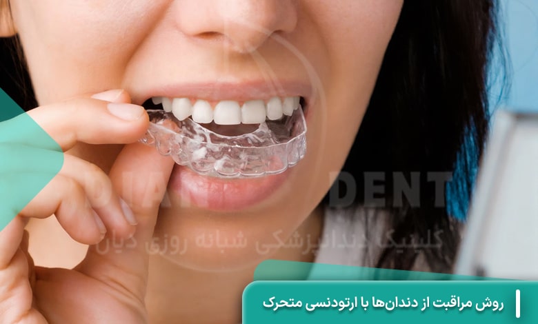 روش مراقبت از دندان‌ها با ارتودنسی متحرک