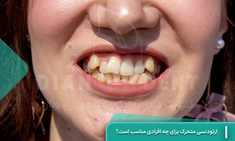 ارتودنسی متحرک برای چه افرادی مناسب است