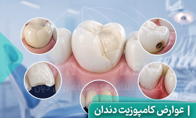 عوارض کامپوزیت دندان