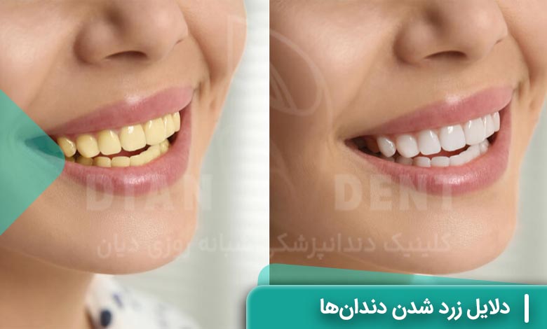 علت زرد شدن دندانها چیست؟ (بررسی 9 علت)