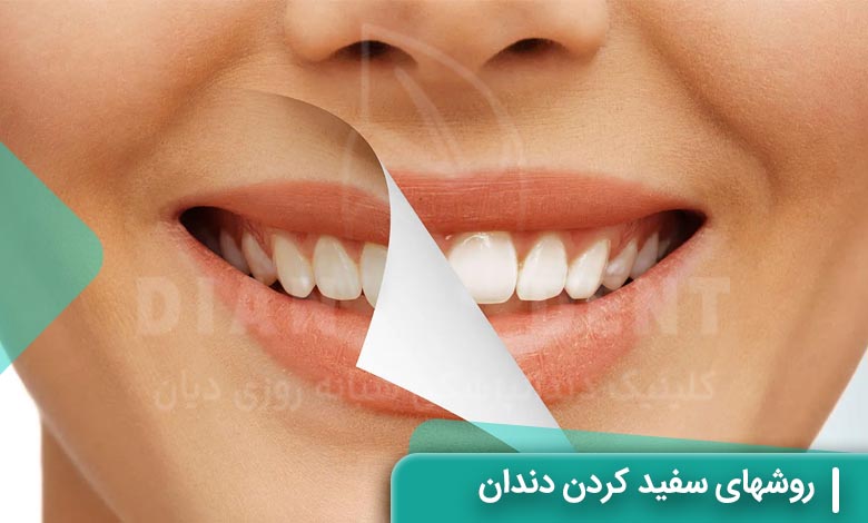روشهای سفید کردن دندان