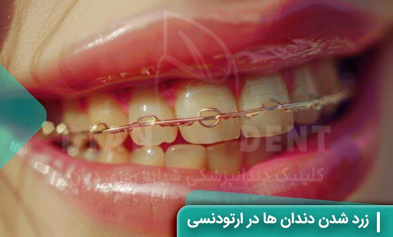 علت زرد شدن دندان ها در ارتودنسی