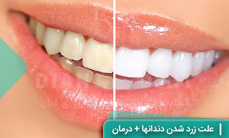 علت زرد شدن دندان ها + روشهای برطرف کردن آن