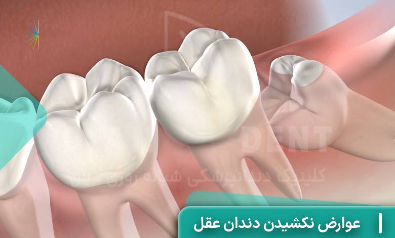 عوارض نکشیدن دندان عقل