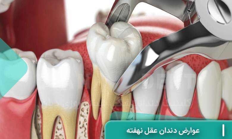 عوارض دندان عقل نهفته