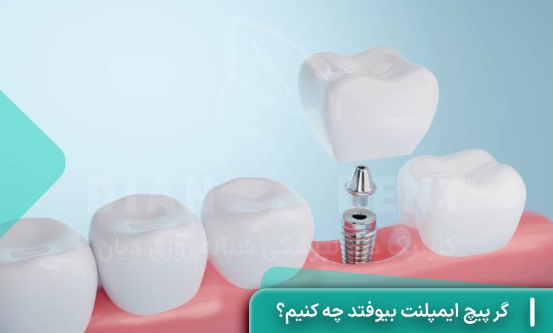 اگر پیچ ایمپلنت بیفتد چه کنیم