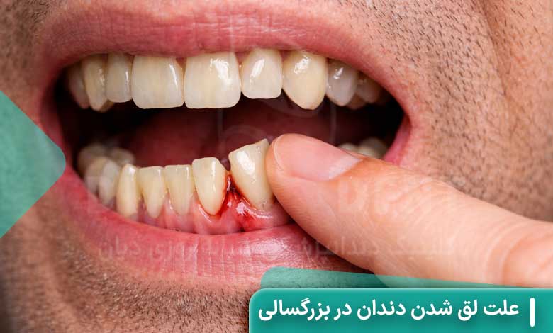 علت لق شدن دندان در بزرگسالی