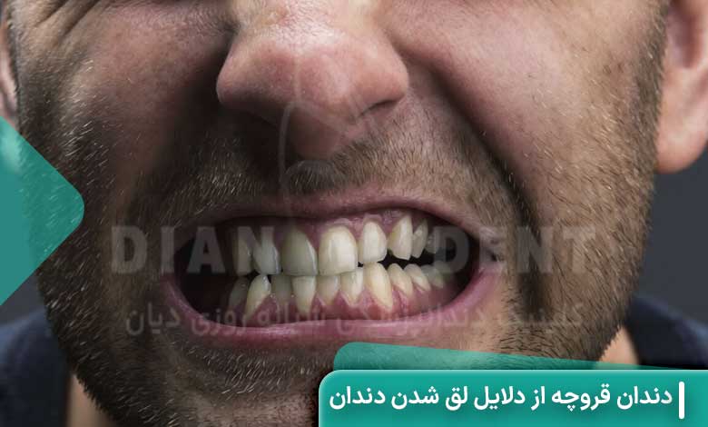 دندان قروچه علت لق شدن دندان در یزرگسالی