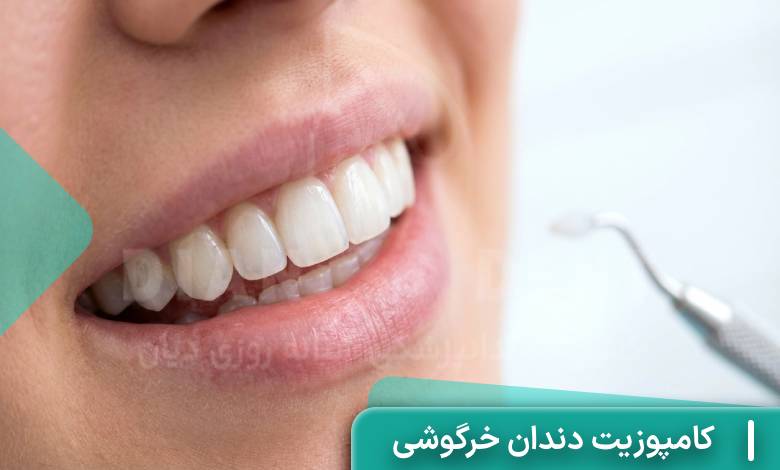 کامپوزیت دندان خرگوشی