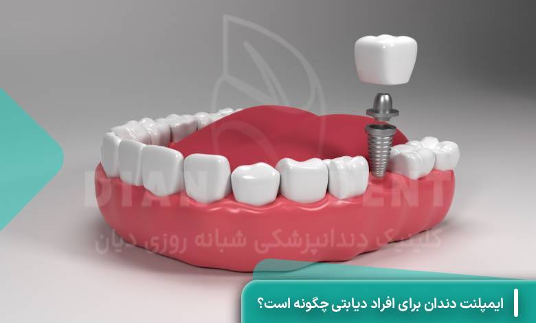 ایمپلنت دندان در افراد دیابتی چگونه است؟
