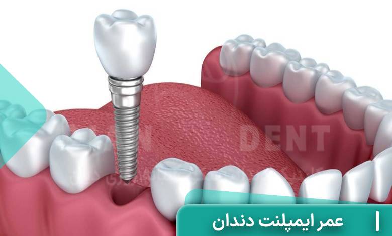 عمر ایمپلنت دندان