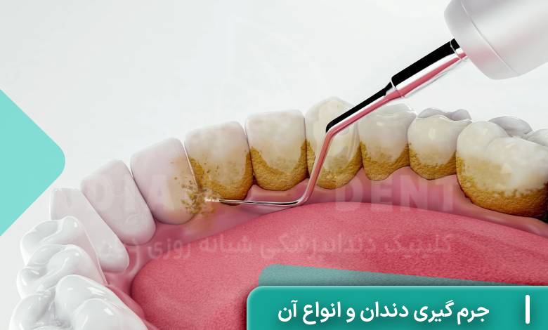 عوارض جرم گیری دندان