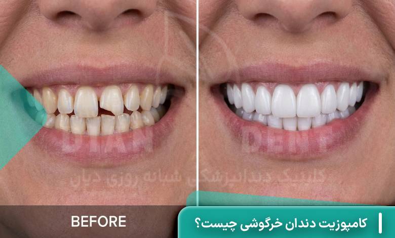 کامپوزیت دندان خرگوشی چیست